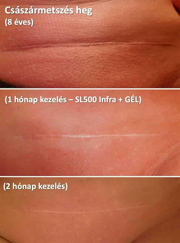 Császármetszés heg kezelése életmód lézerrel