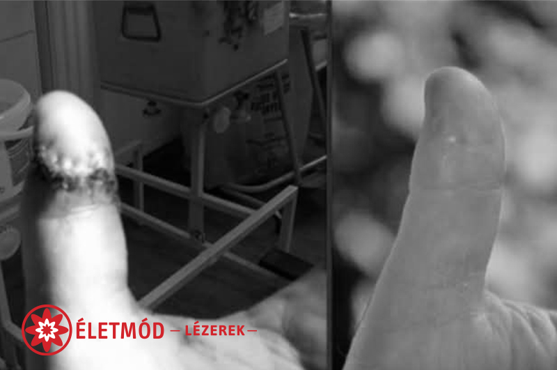 stroke kezelése életmód lézerrel