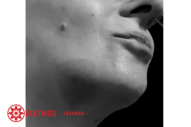 torokgyulladás kezelése életmód lézerrel